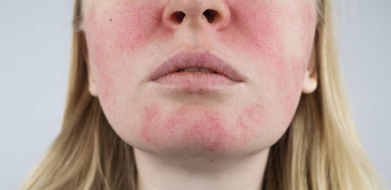 Closeup of a woman with rosacea on her face.